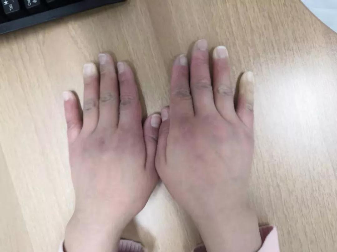 “手指、腳趾發(fā)白、發(fā)紫……”這些“小毛病”千萬別大意