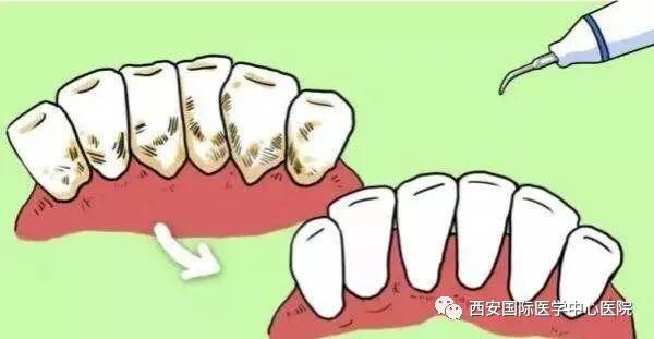 【科普】牙齒上的黃斑好難看，三招告訴你如何預(yù)防氟斑牙