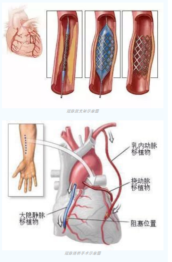 魚與熊掌不可兼得？冠脈雜交手術(shù)一站式解決問題