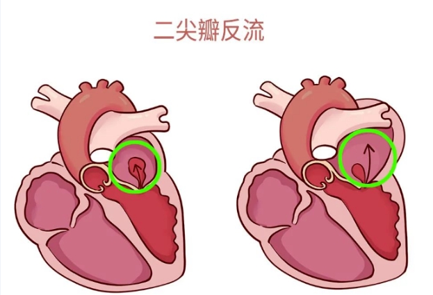 體檢報告里的心臟瓣膜反流，你讀懂了嗎？